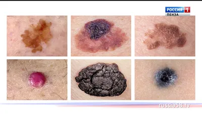 Рак кожи (Меланома) | MedKontrol Маріуполь