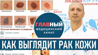 Немеланомный рак кожи: диагностика и лечение