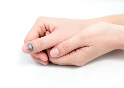 Не просто синяк: какая отметина на ногте может говорить о редкой форме рака