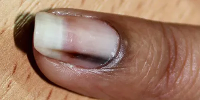 Что означают черные ногти?