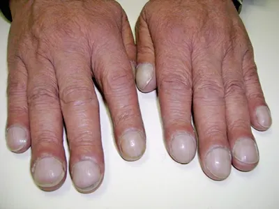 Присмотритесь к ногтям: онколог назвал опасный симптом рака, который легко  заметить на маникюре - 17 апреля 2023 - НГС