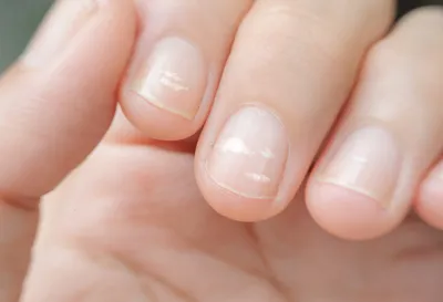 О чем сигнализируют пятна разных цветов на ногтях – симптомы, лечение и  профилактика