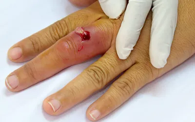Меланома ногтя: симптомы, диагностика, лечение и прогноз