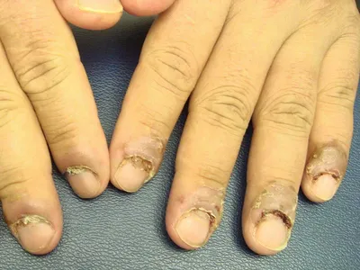 Подногтевая меланома, рак ногтевой пластины: излечение, симптомы, начальная  стадия рака ногтя | Клиники «Евроонко»