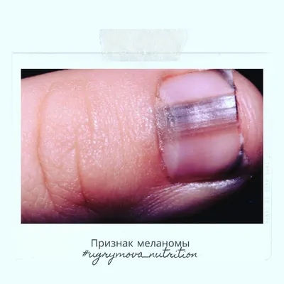 Ушиб ногтя – симптомы, виды, методы лечения, осложнения и риски,  профилактика