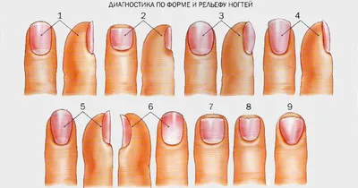 Подногтевая гематома - причины, симптомы, диагностика, лечение и  профилактика