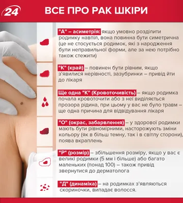 Стекачева Ирина - Подногтевая меланома Меланома ногтя... | Facebook