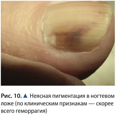 Подногтевая меланома: фото начальной стадии, симптомы и признаки меланомы  ногтя, диагностика и лечение в Москве