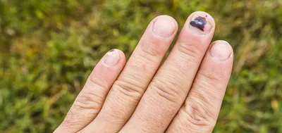 Не просто синяк: какая отметина на ногте может говорить о редкой форме рака