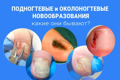 Гематома под ногтем – это повреждение сосудов подногтевой дермы и излияние  крови под ногтевую пластину. ⠀ Например: вы ударили чем-то по пальцу,... |  By Аппаратный педикюр SUDA \"Зюда\" | Facebook