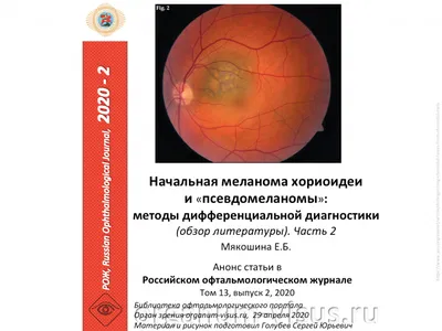 Меланома сетчатки глаза фото фото