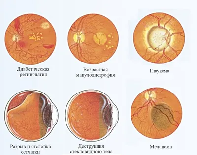 Офтальмоскопия глазного дна (осмотр с широким зрачком) - цены в Москве