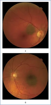Невусы хориоидеи: особенности клинического течения