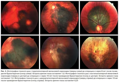 Рис. 3. Фотографии глазного дна с парапапиллярной меланомой хориоидеи …