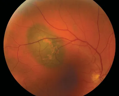 Клиническая онкология органа зрения