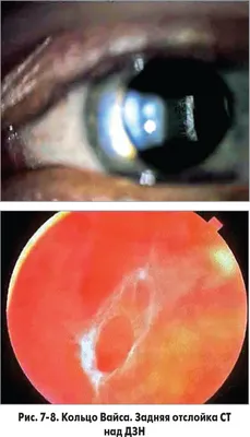 Ретиношизис — что за патология и почему она возникает? «Ochkov.net»