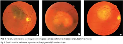 Рис. 1. Начальная меланома хориоидеи: пигментированная (а), слабопигме…