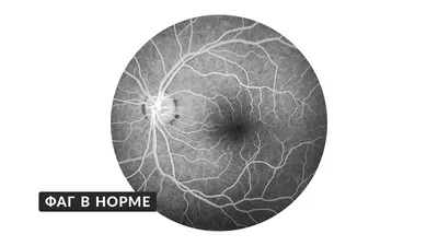 Рак глаза - симптомы, признаки, стадии, лечение