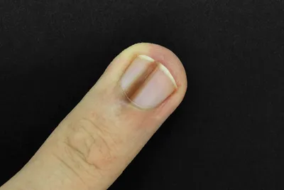 Центр подологии SÜDA - Пятна и полосы на ногтях только с виду кажутся  безопасными. ❗МЕЛАНОНИХИЯ - это гиперпигментация ногтя от коричневого до  черного за счет отложения меланина. ⚠️ Может свидетельствовать о серьезном