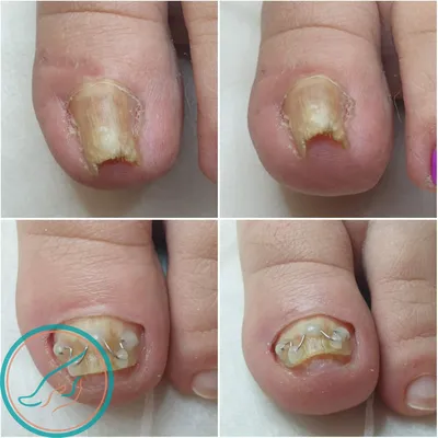 Изменение ногтевой пластины — Курсы по дерматоскопии | Юрий Сергеев