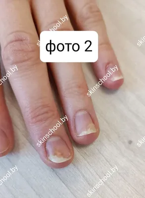 Лечение ногтей СПб. Лечение болезней ногтей в Nail Clinic