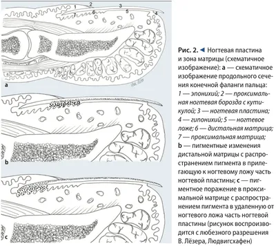 Изменение ногтевой пластины — Курсы по дерматоскопии | Юрий Сергеев