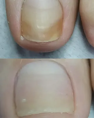 Изменения ногтей (фото заболеваний в конце) | Советы  дерматолога|Sovetydermatologa | Дзен