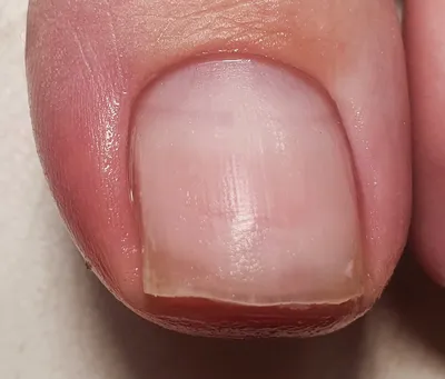 Наличие пигментной линии под ногтевым ложем. Симптомы и лечение меланонихии.  Причины возникновения меланонихии
