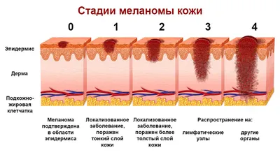 Меланома кожи. Диагностика и лечение