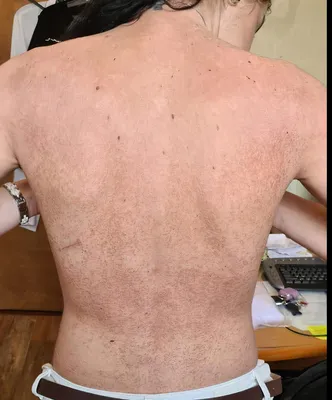 A rare case of follicular sarcoidosis - Gritskova - Vestnik dermatologii i  venerologii