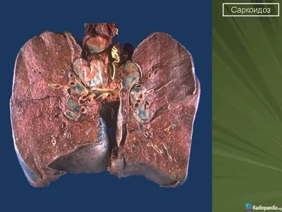 Саркоидоз 1. + | Портал радиологов