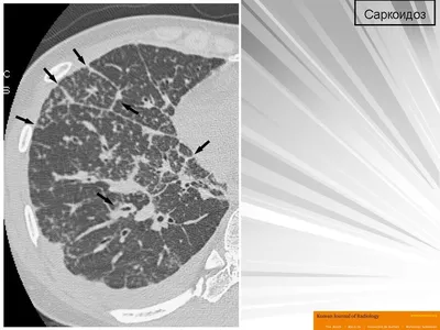 Саркоидоз 1. + | Портал радиологов