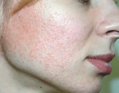 Клинический пример эффективности антибактериальной терапии при саркоидозе  кожи