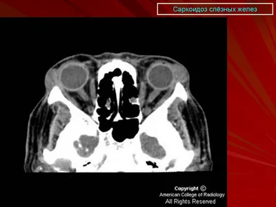 Саркоидоз 1. + | Портал радиологов
