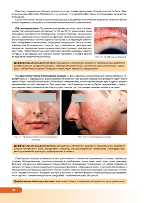 A rare case of follicular sarcoidosis - Gritskova - Vestnik dermatologii i  venerologii