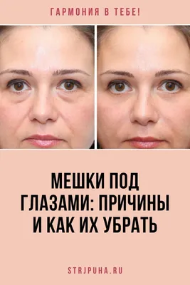 CHEEK LIFT LIGHT. Американский подход к омоложению.