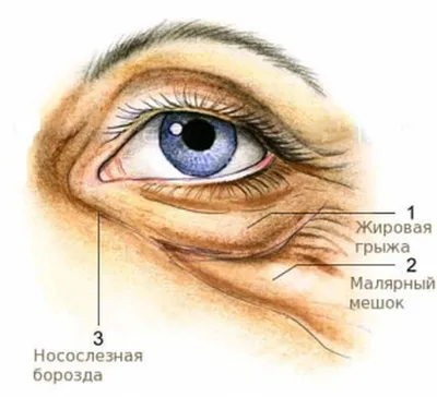 ▪️Малярные мешки на... - Пластическая хирургия Пластика СПБ | Facebook