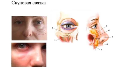 Мешки под глазами: причины появления и как избавиться - Urosvit