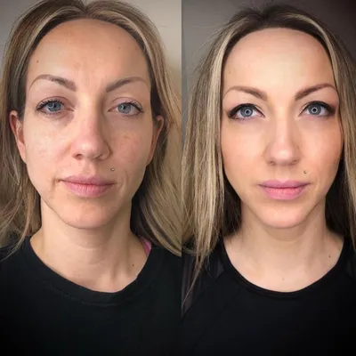 Работа над собой - Маша о курсе косметологических процедур | Beauty Insider