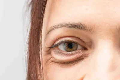Мешки под глазами: причины и методы борьбы с ними | Christina Cosmetics