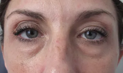 Малярные мешки под глазами: как убрать? | Lifting Lab