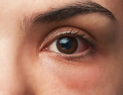 Причины возникновения темных кругов под глазами у мужчин. Cиняки и темные  круги под глазами у мужчин: как избавиться