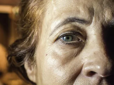 Синяки под глазами: причины темных кругов под глазами у женщин и мужчин