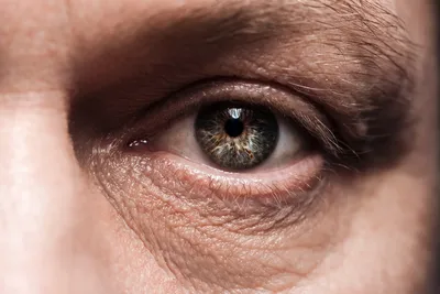 Почему возникают мешки под глазами у мужчин? Как от них избавиться |  Хирургия красоты | Дзен