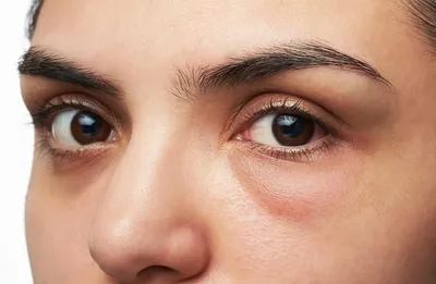 Круги под глазами — почему возникают и как их лечить | Блог | Complimed