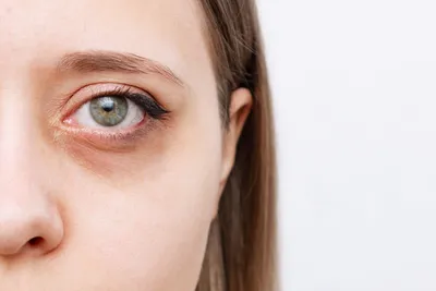 Как убрать синяки под глазами мужчине: причины и лечение темных кругов