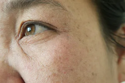 Омолаживаем область глаз липофилингом - Cosmetic-clinic