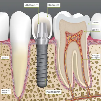 Металлокерамическая коронка на имплант - цена протезирования  металлокерамикой зубов