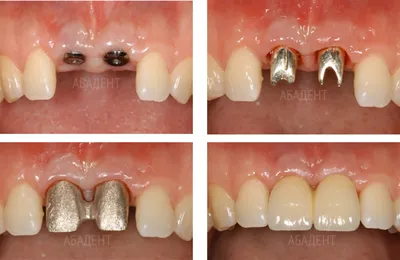 Металлокерамические коронки на имплантах на Павелецкой