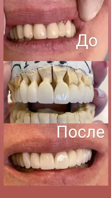 Металлокерамическая коронка [цена установки от 18 000 ₽ в Москве]